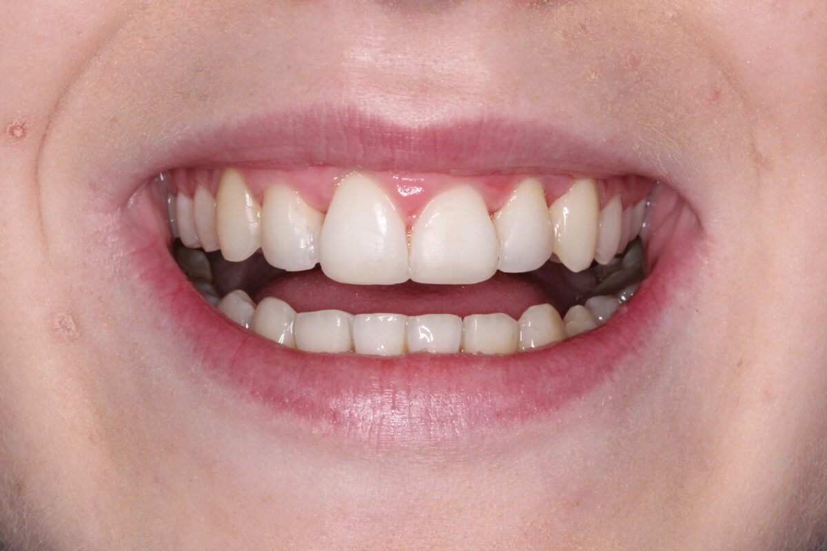 Picture of Sineads smile after composite bonding
