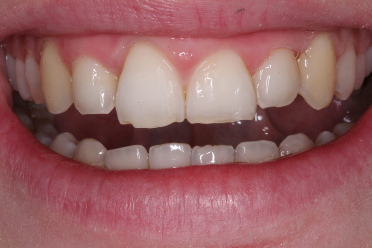Picture of Sinead before she received composite bonding