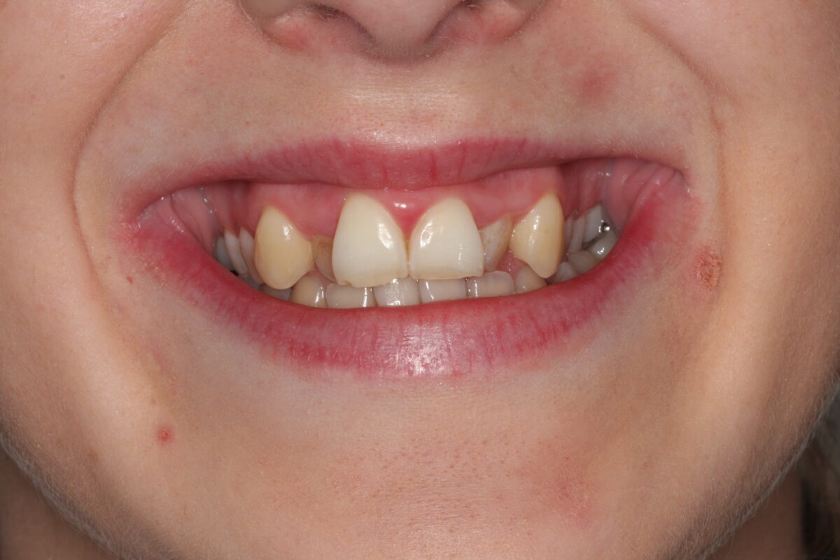 Image of patient before commencing Invisalign and Composite bonding treatment