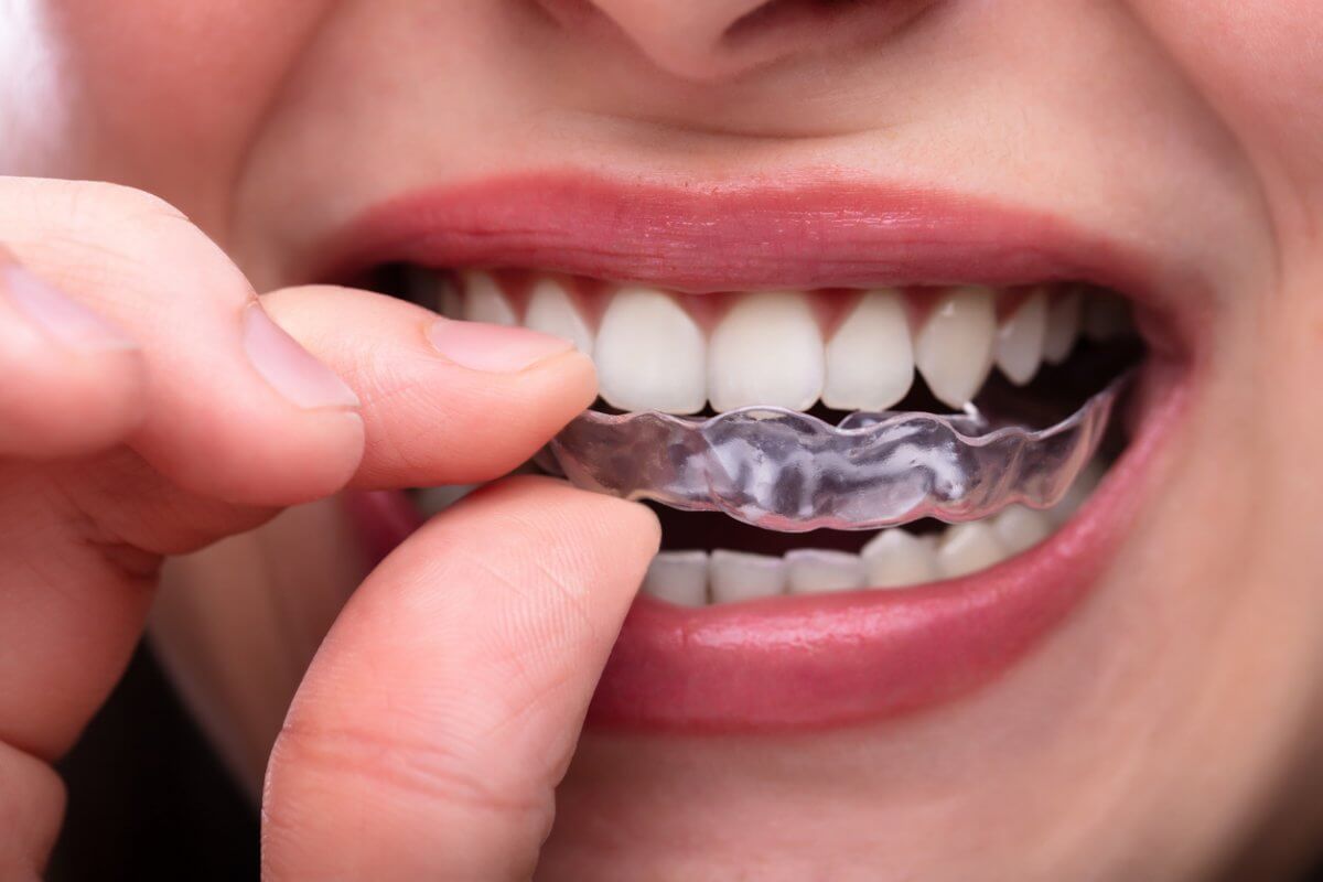 Mouth Guard for teeth grinding
