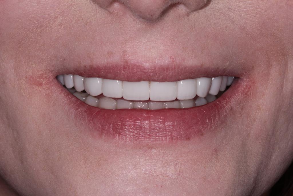 After a combined treatment including, veneers, teeth whitening, dental bridge and invisalign clear braces.