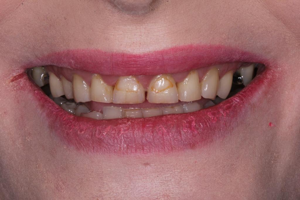 Before a combined treatment including, veneers, teeth whitening, dental bridge and invisalign clear braces.