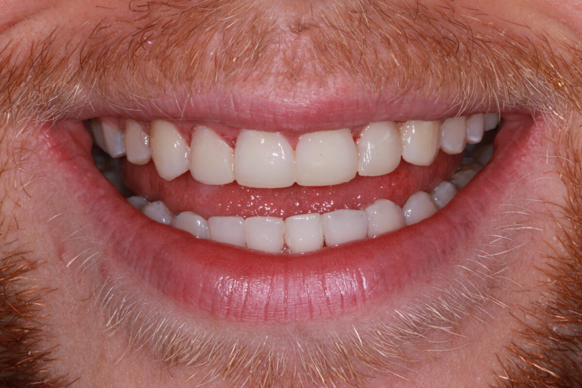 after invisalign and composite bonding