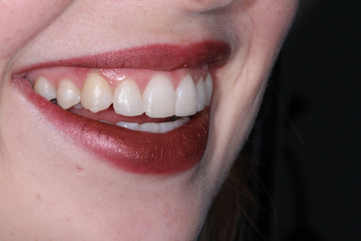 Terrie after invisalign treatment
