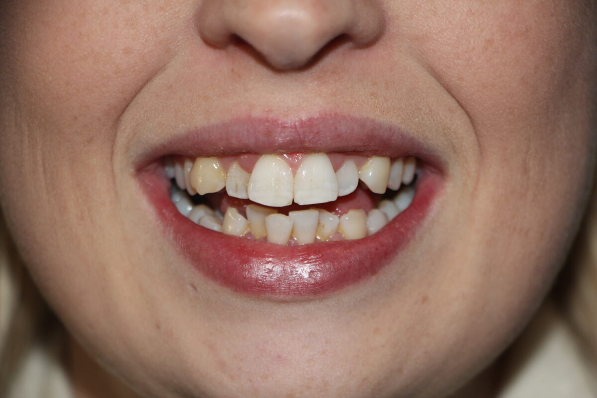 Terrie before Invisalign clear braces treatment