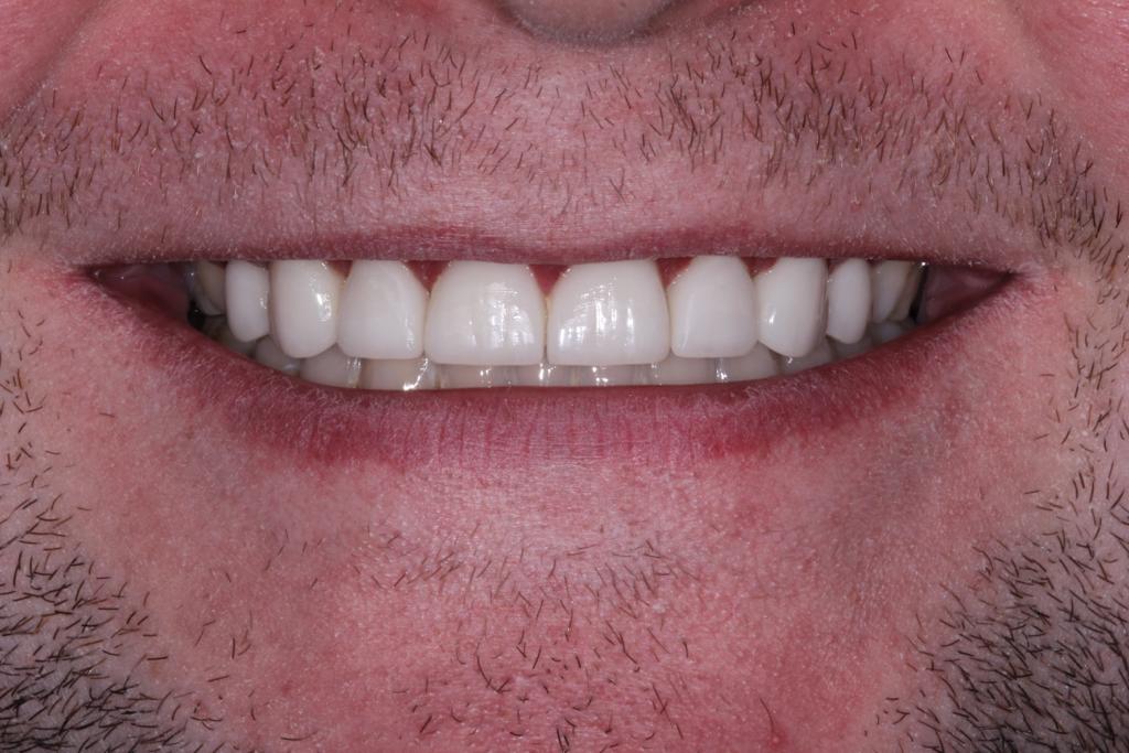 composite veneers and teeth whitening after treatment